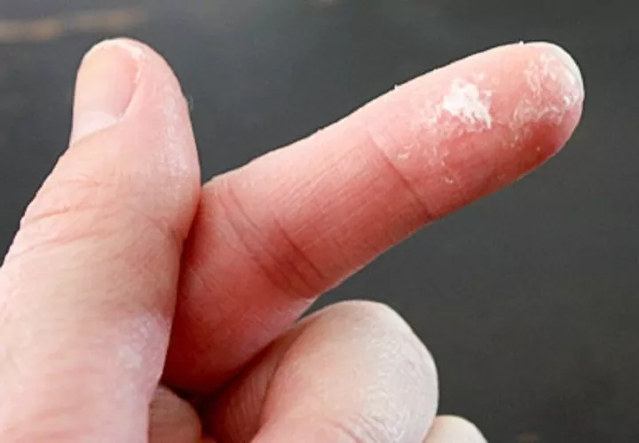 remove super glue off skin